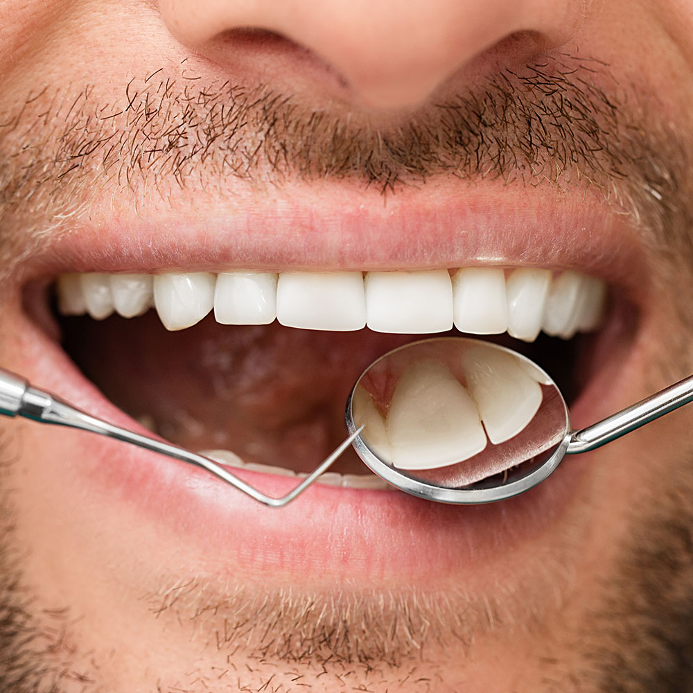 Lost filling dental exam in Downey